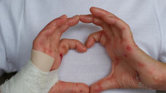 Pomáhejte s Forbesem. Díky příspěvku přijala organizace Debra terénního sociálního pracovníka